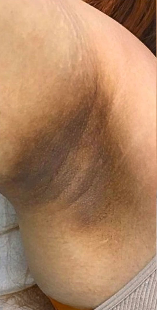 Before — Underarm Discoloration
