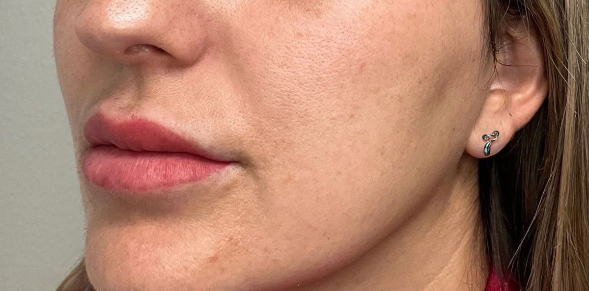 After — Acne Scars