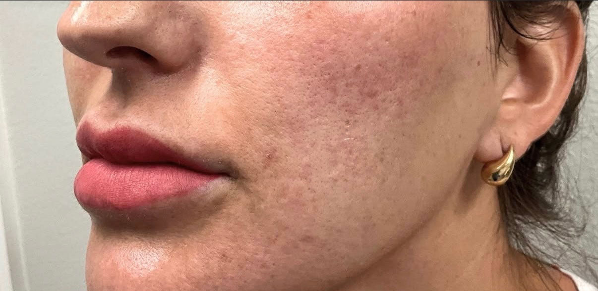 Before — Acne Scars